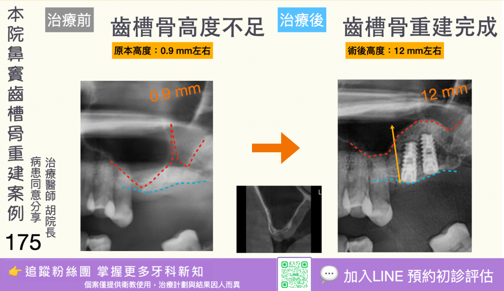 人工植牙治療實際案例成果173