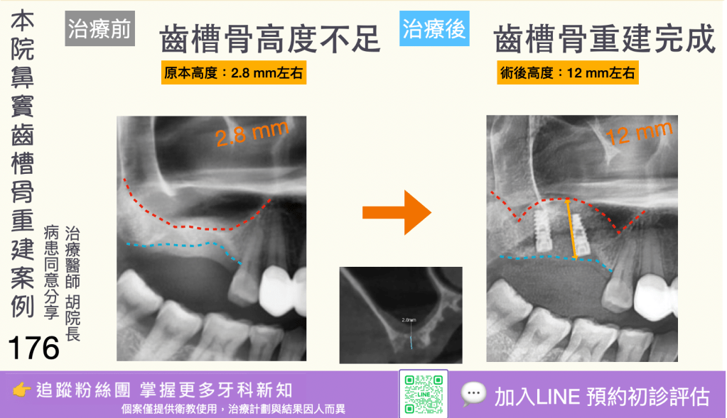 人工植牙治療實際案例成果174