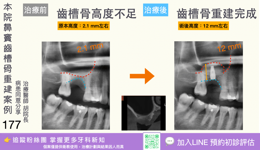 人工植牙治療實際案例成果175