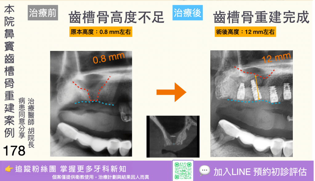 人工植牙治療實際案例成果176