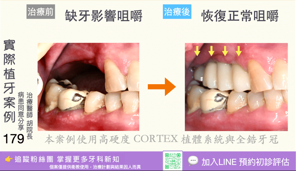 人工植牙治療實際案例成果177