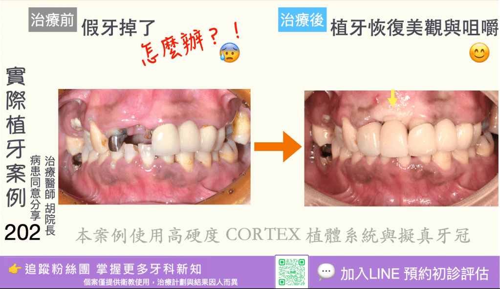 人工植牙治療實際案例成果200