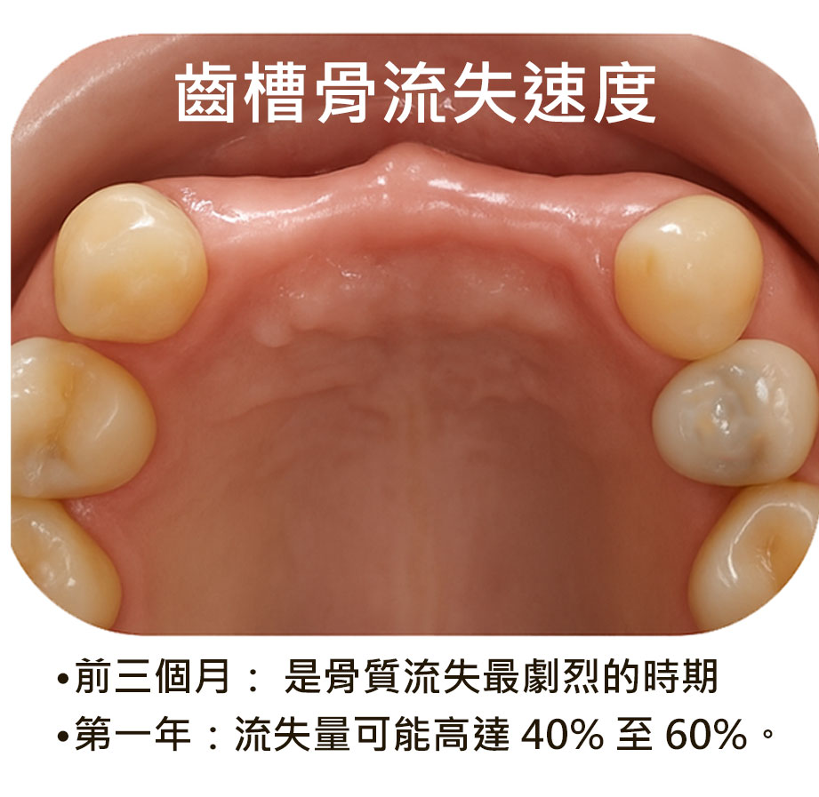 齒槽骨流失速度分析圖